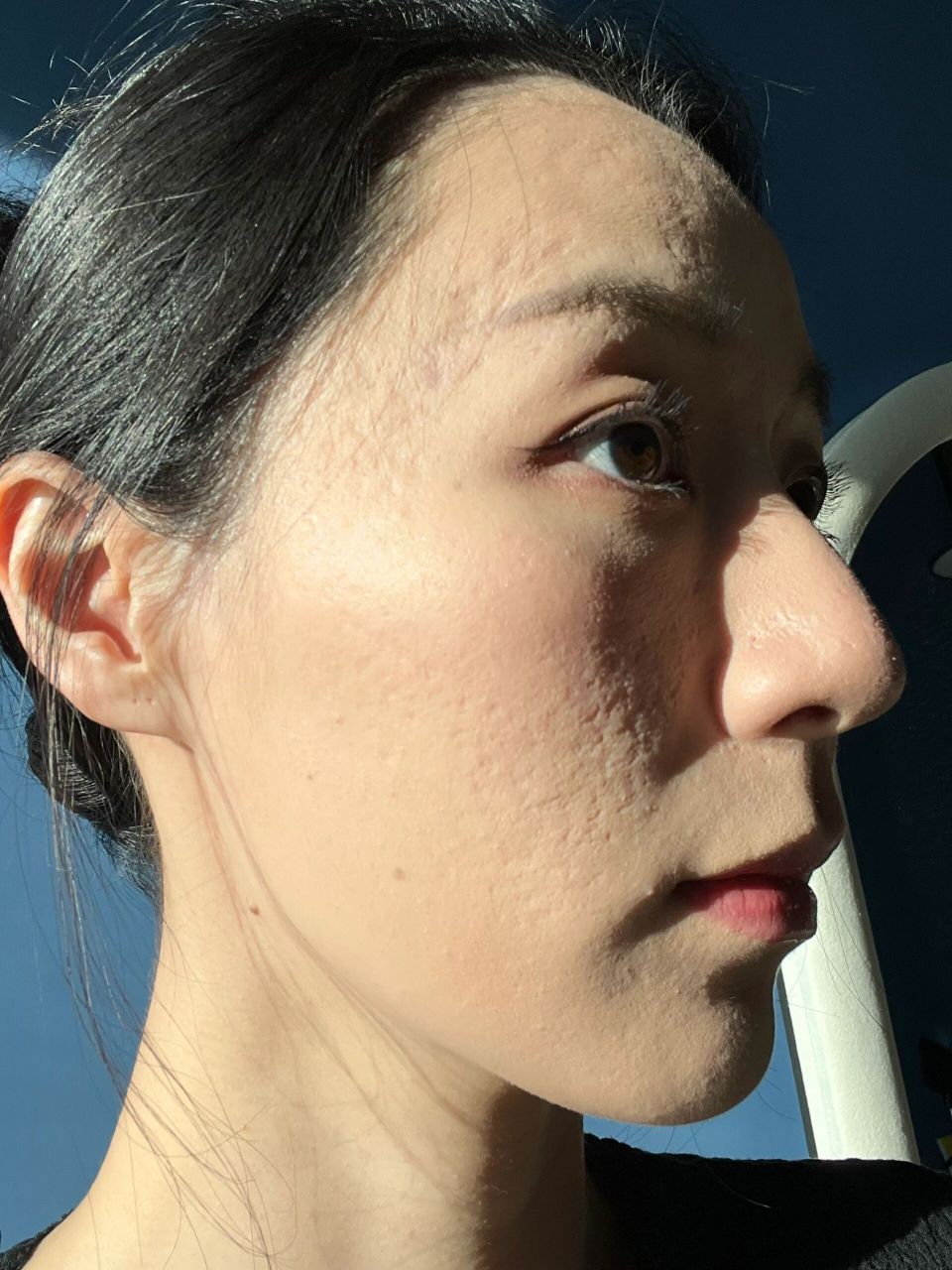 太阳穴的痘坑平太多了吧!