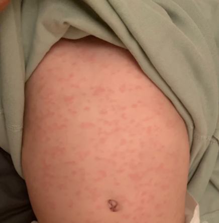 第一次给孩子吃芒果时,要特别注意有没有过敏症状,比如嘴唇