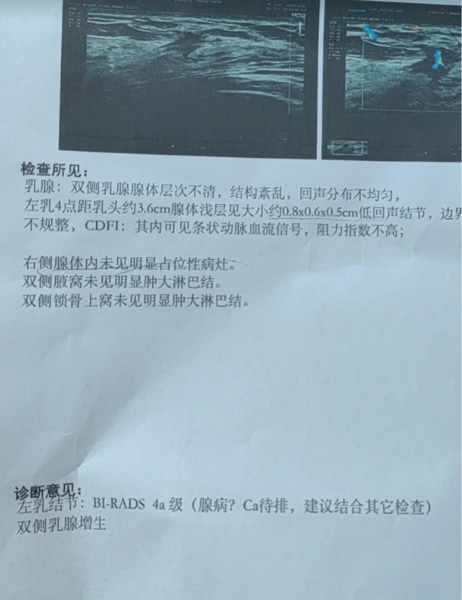 bi-rads4a类乳腺结节什么意思?