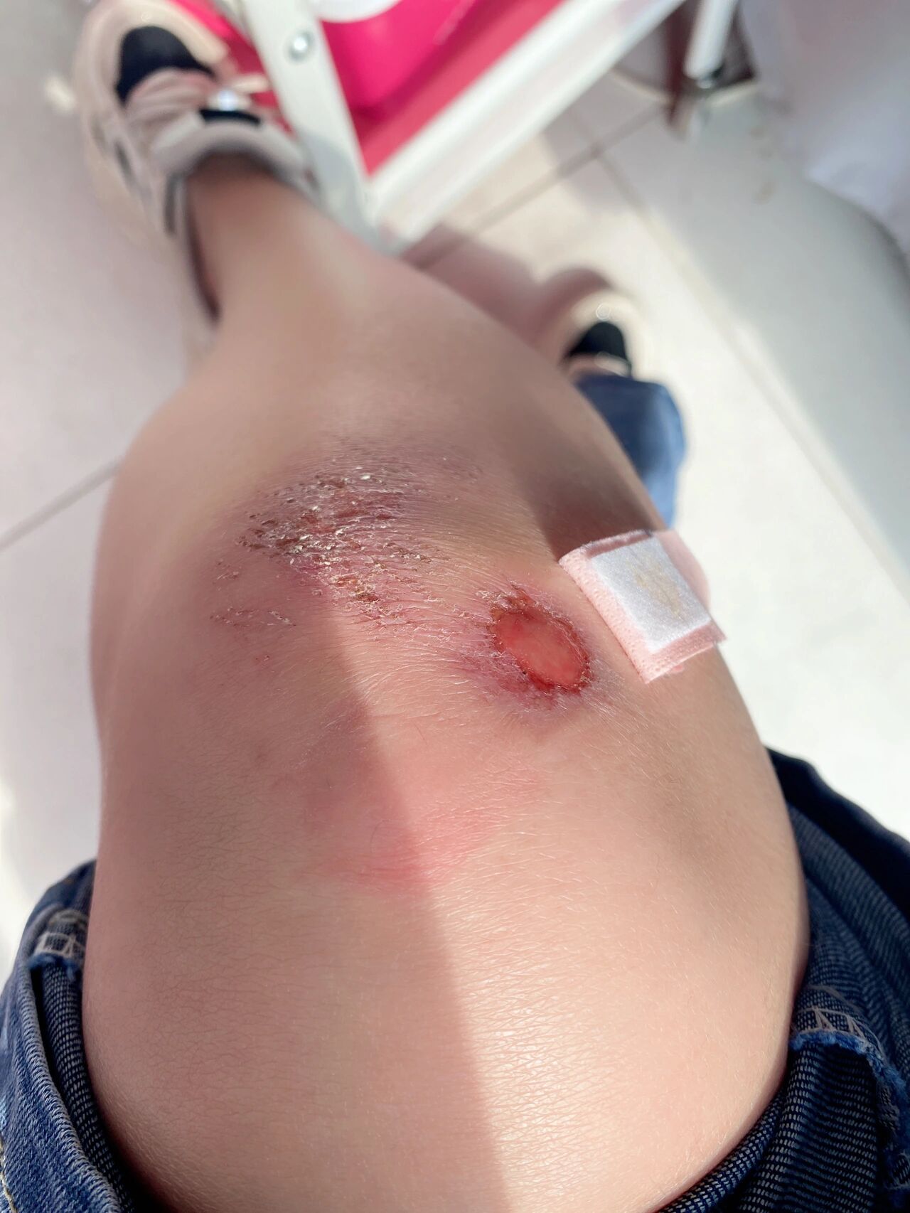 膝盖摔破第八天 好多了,不能吃辣椒,吃了几天更疼