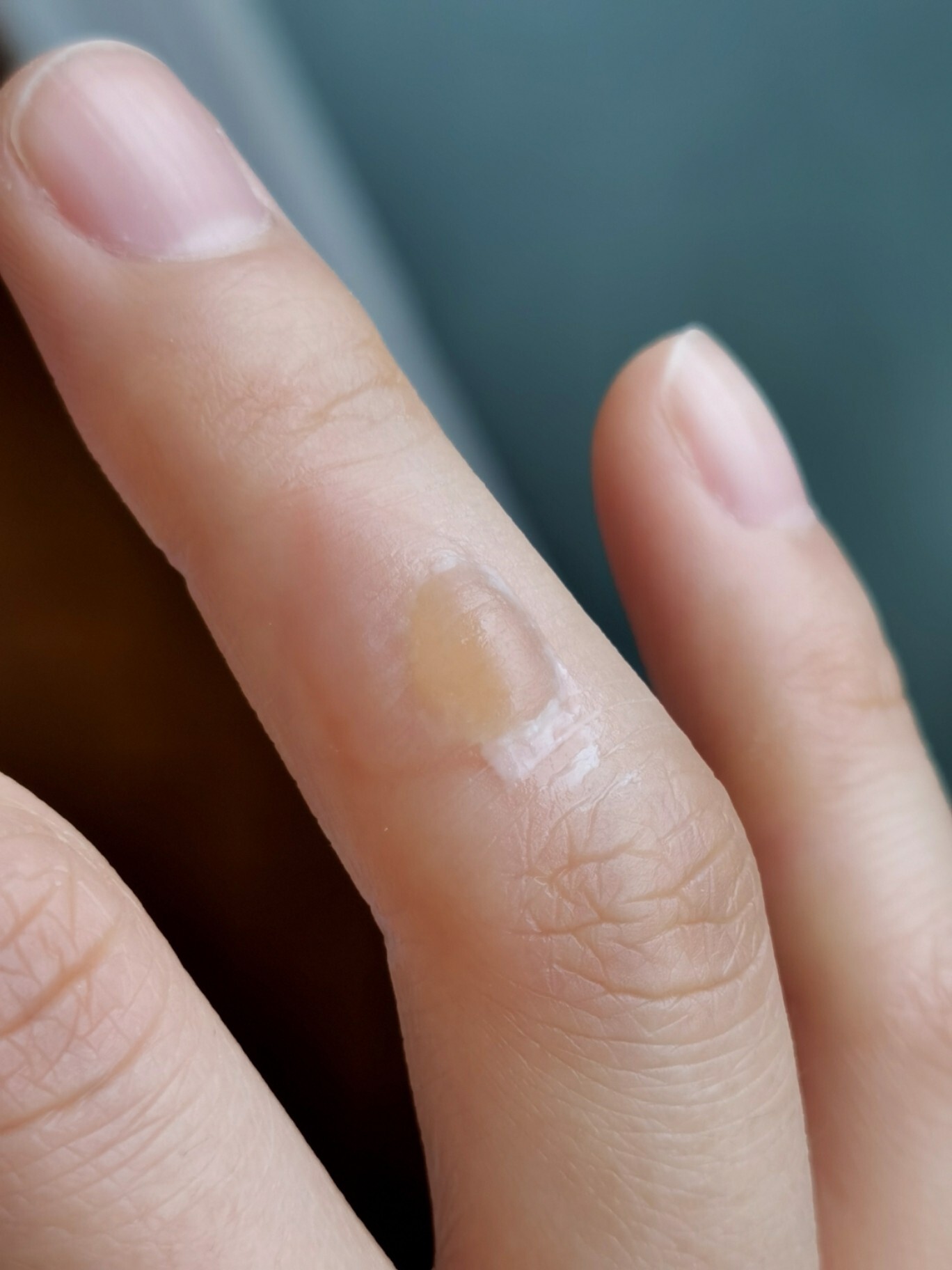 烫伤起泡怎么破!