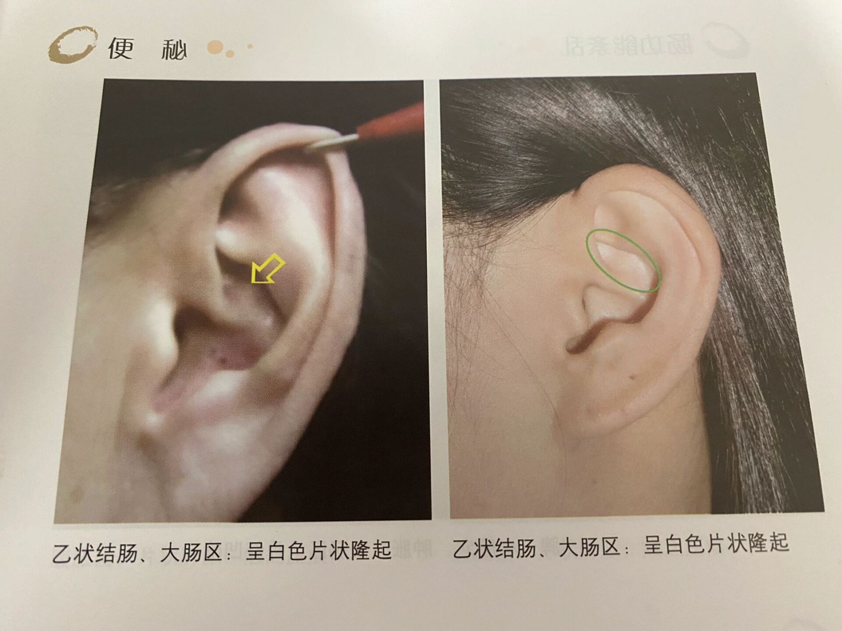 900169♀1501「神奇耳穴」观耳知便秘 临床中,我经常给病人