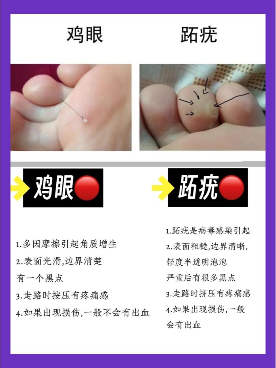 好用鸡眼贴选对不选贵! 姐妹们看完不吃亏!好用的鸡眼贴测评分享来喽!