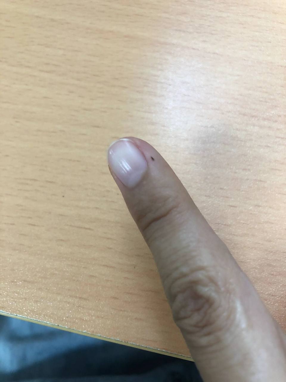 这个手指上的黑点是什么 以前撕"倒枪刺"撕坏了 留下的结痂 以为自己