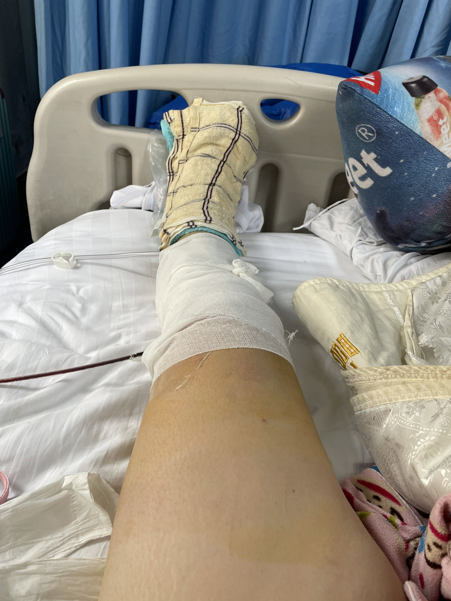 骨折日记|胫骨平台骨折day13 满打满算,今天是骨折后的第13天,想记录