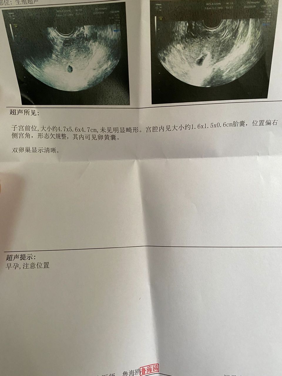 孕囊偏右侧宫角 感觉又和上次的情况一样了 孕囊还是偏右侧 翻倍也卡