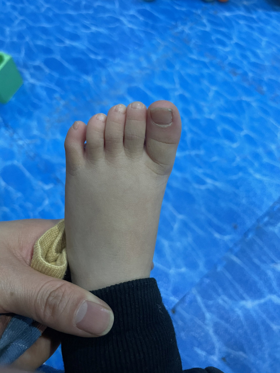 宝宝脚趾头往一边歪图片