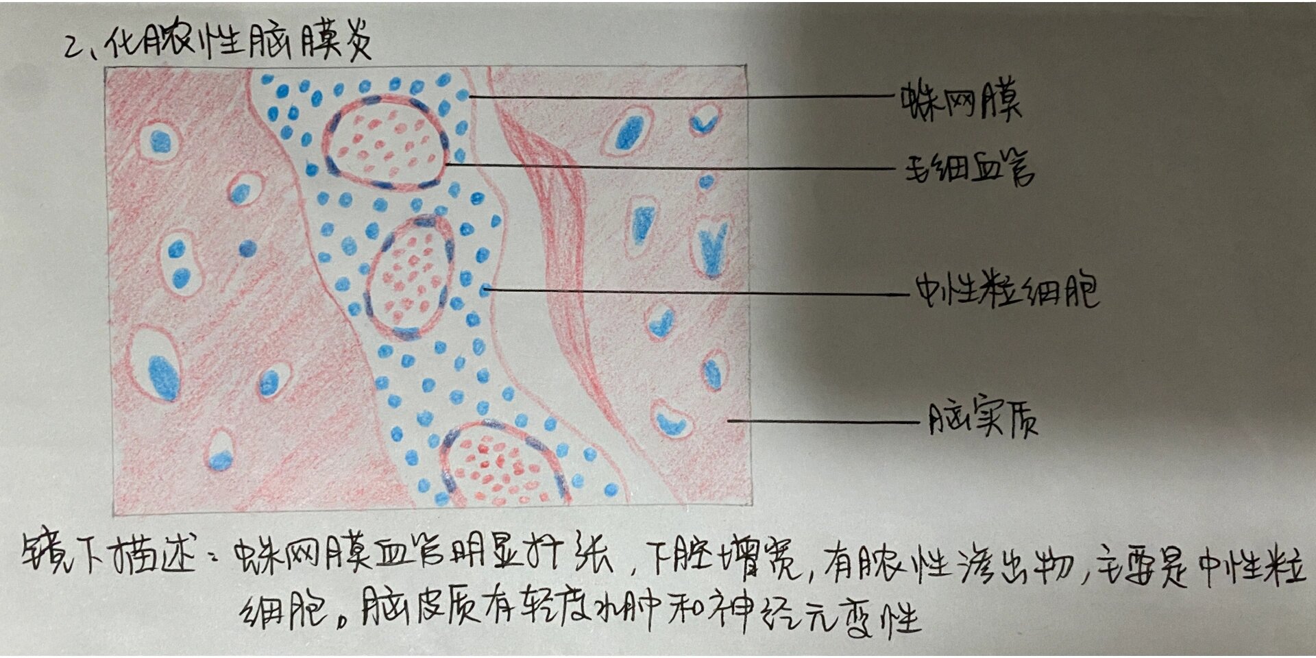 化脓性脑膜炎红蓝绘图图片