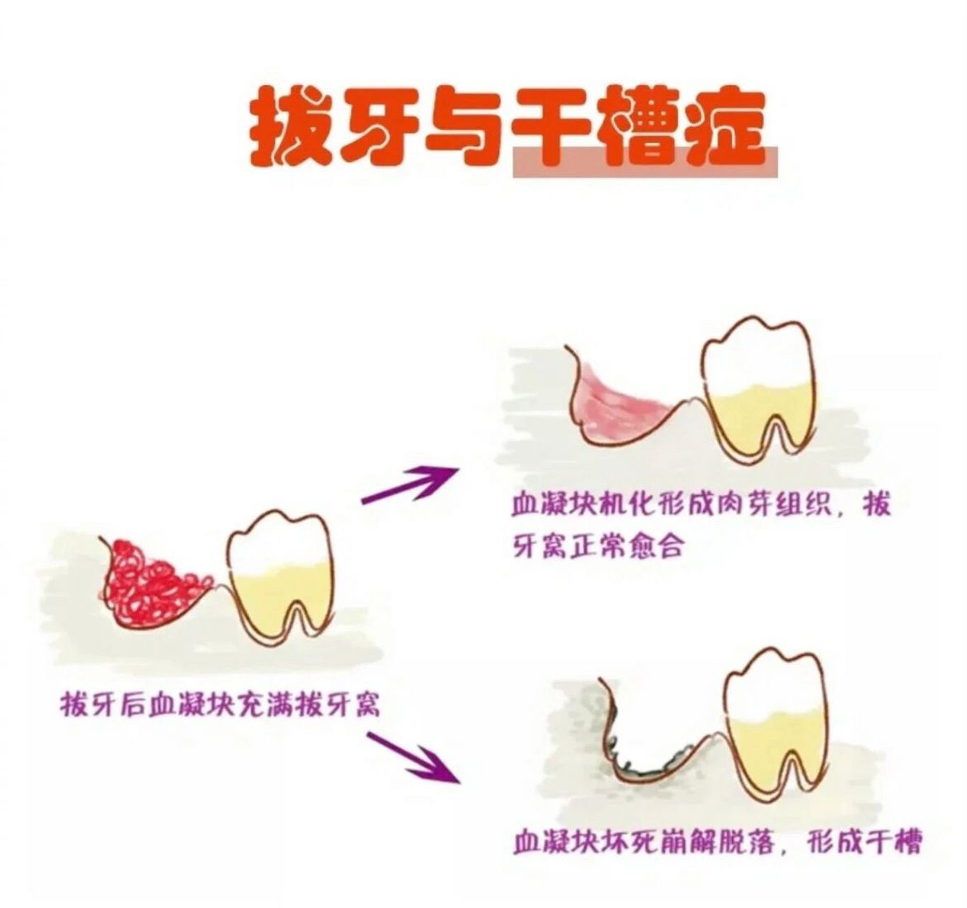 拔智齿后喜提干槽症后续 今天是拔智齿第11天,刮骨第4天,刚从医院回来