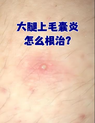 大腿上毛囊炎的根治需要综合多种方法,以下是一些有效的治疗建议