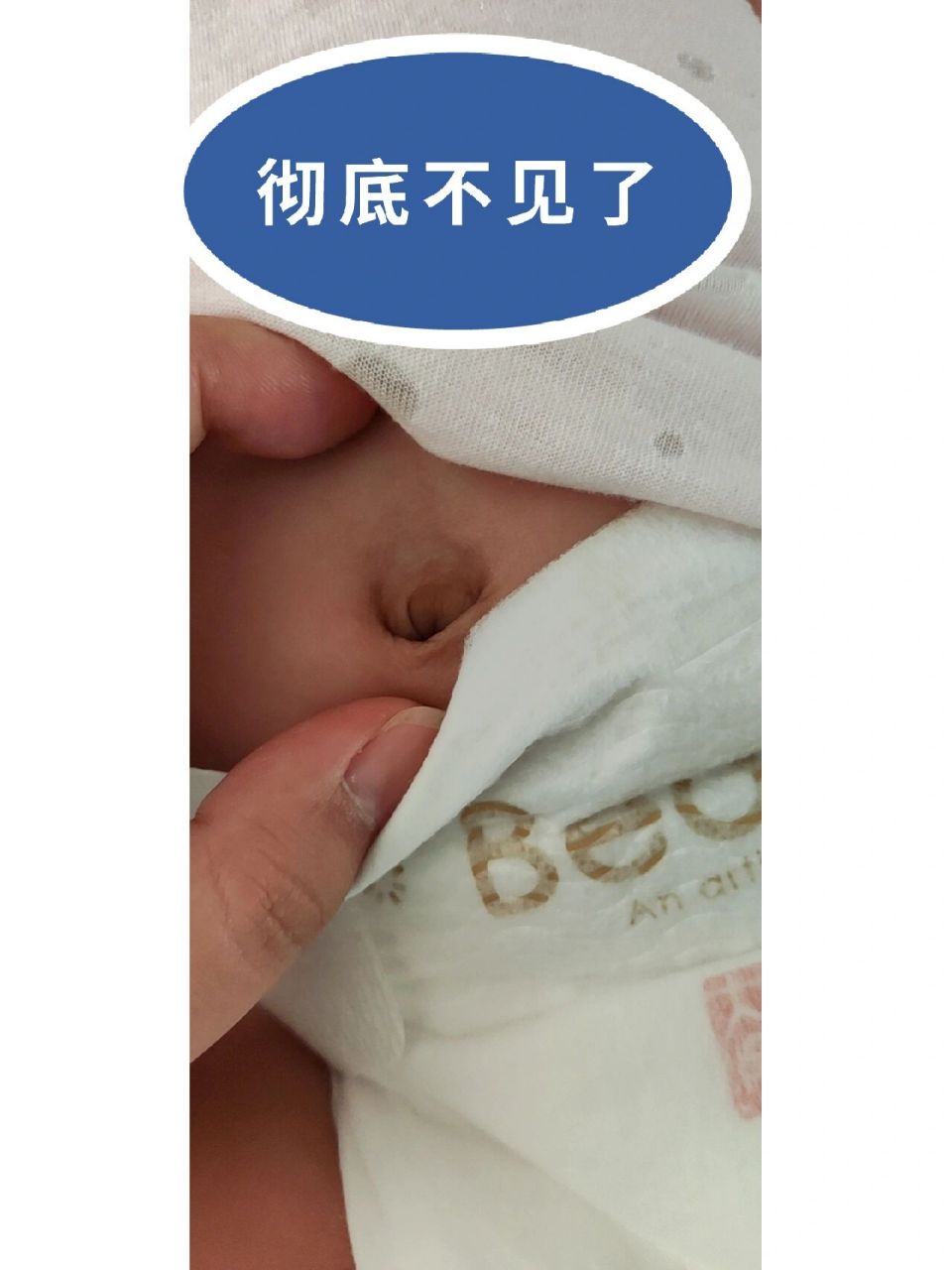 小心发展成脐炎 出生15天肚脐掉落,有个这样的肉球.