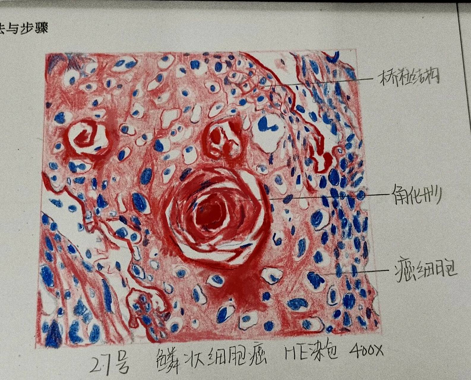 红蓝铅笔画图 磷状细胞癌 #医学生笔记# #医学生# #医学# #铅笔手绘