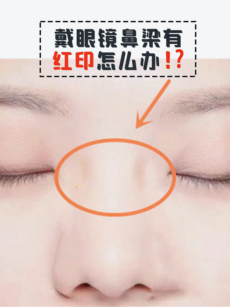 戴眼镜鼻梁有红印怎么办6315 我是科普君,干货满满建议收藏60