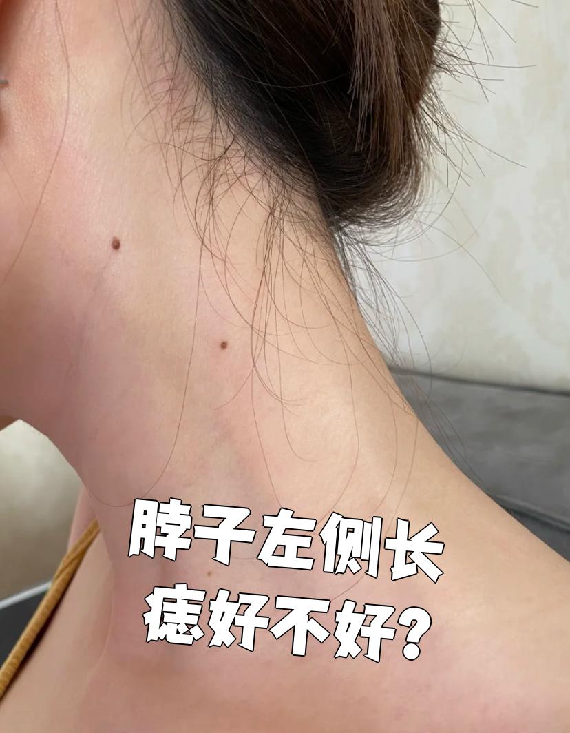 脖子左侧长痣本身不是什么大问题,主要就是可能影响外观