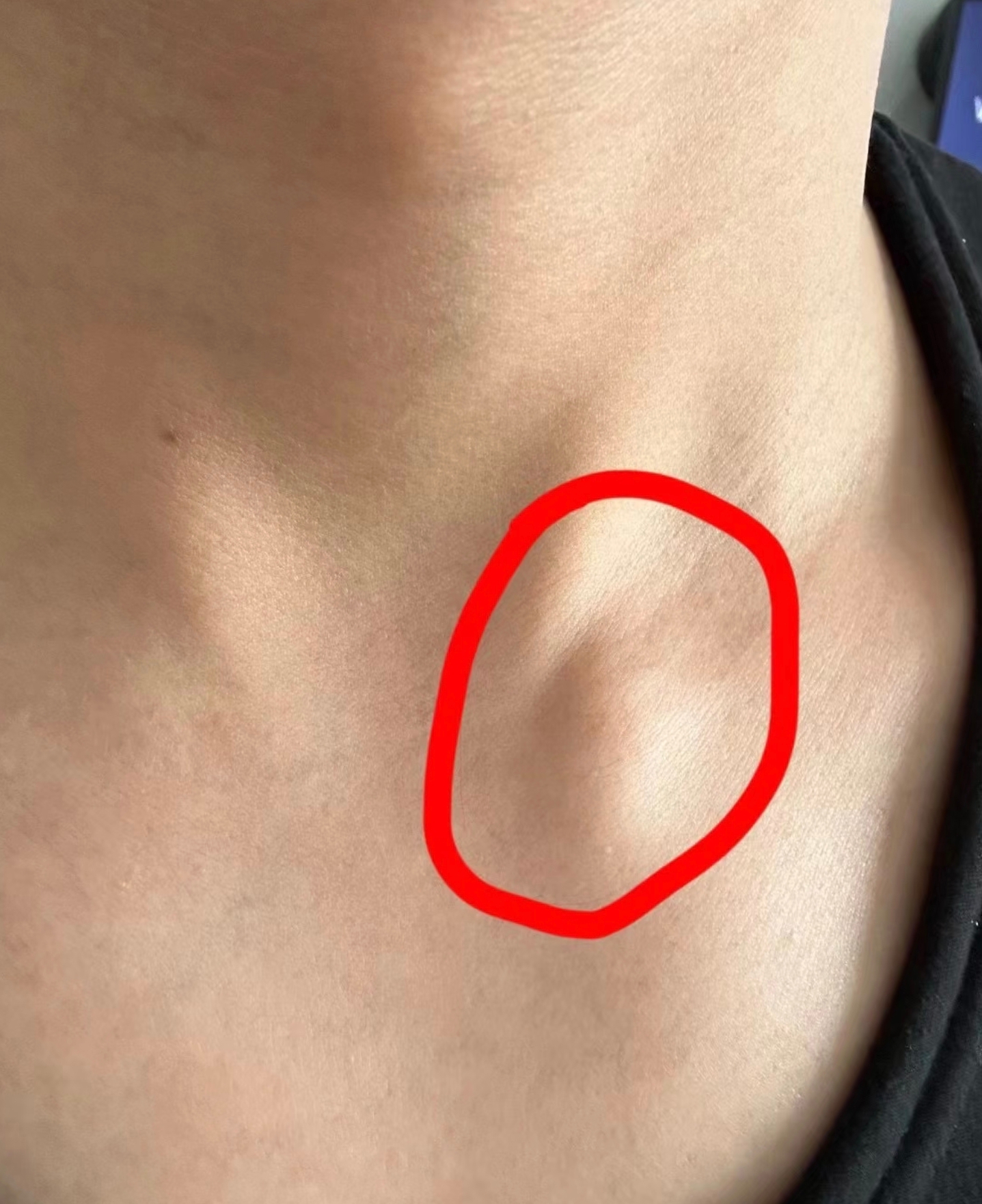 比如陈旧性锁骨骨折,锁骨上淋巴结肿大,单纯性甲状腺肿,甲状腺功能