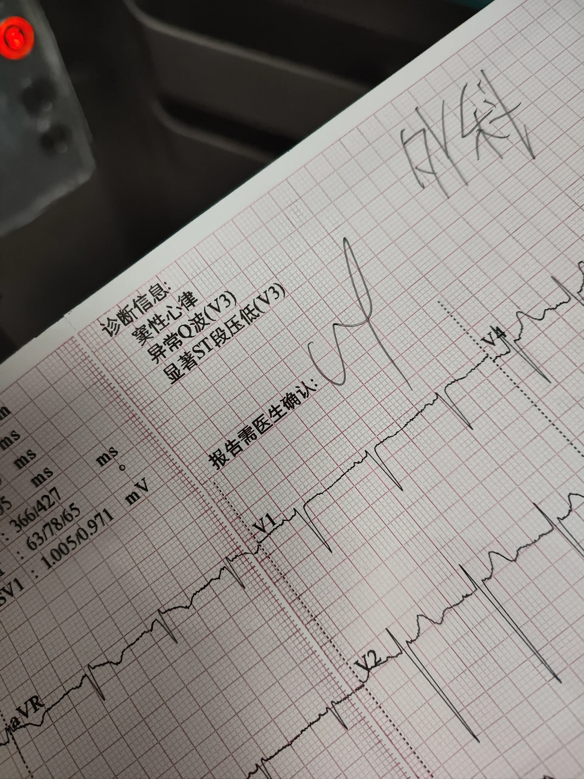 心电图 q波异常,显著st段压低,窦性心律,这很严重吗[流泪][流泪][流泪