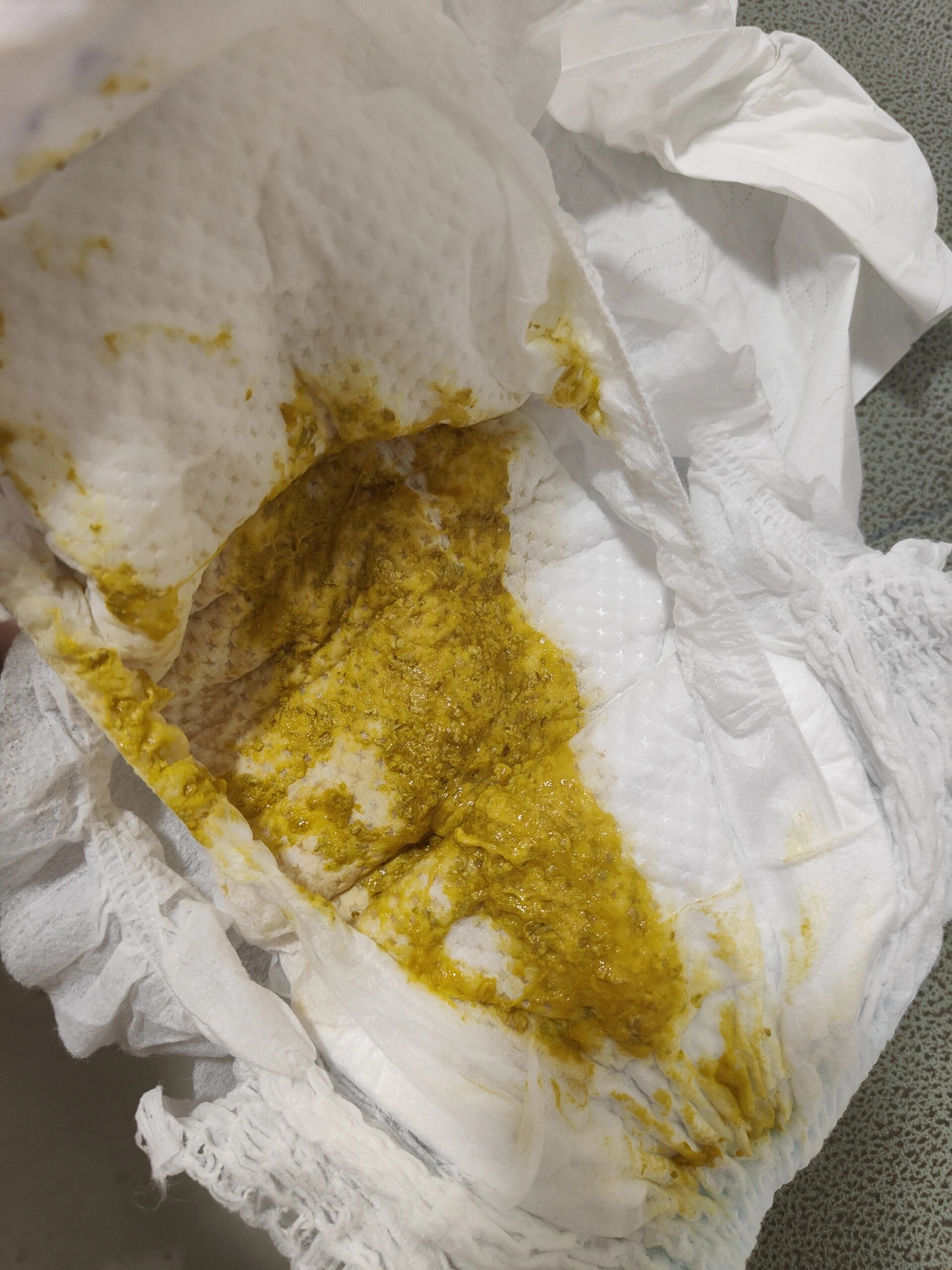 三个月宝宝腹泻拉肚子 求助,肺炎出院后拉肚子,喝了助宝康益生菌和