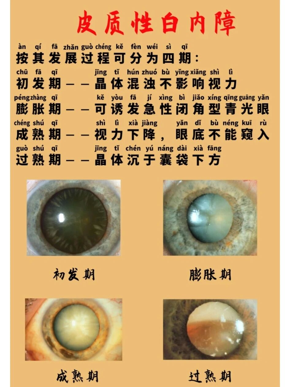 白内障四期分类图片图片