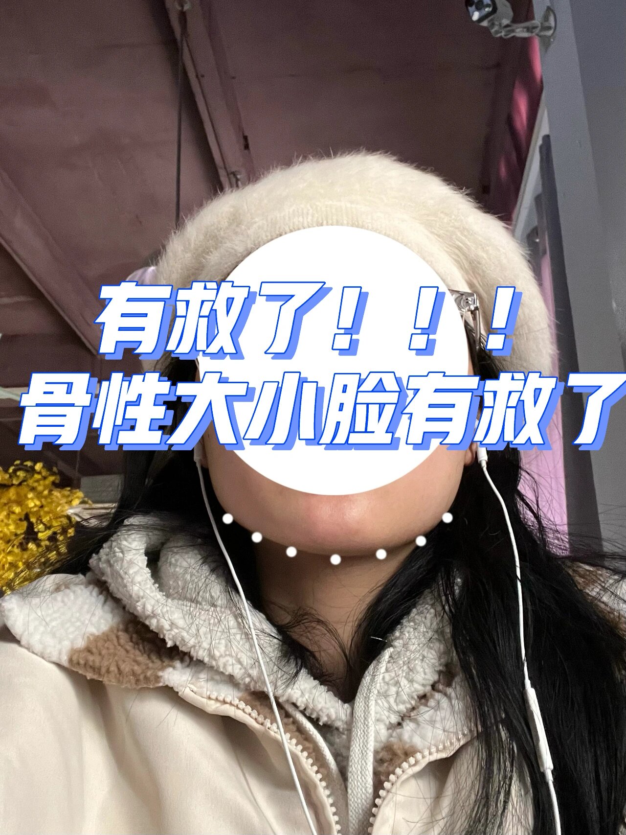 骨性大小脸终于得救 大小脸很久了,之前说的托腮法改善得比之前快太多