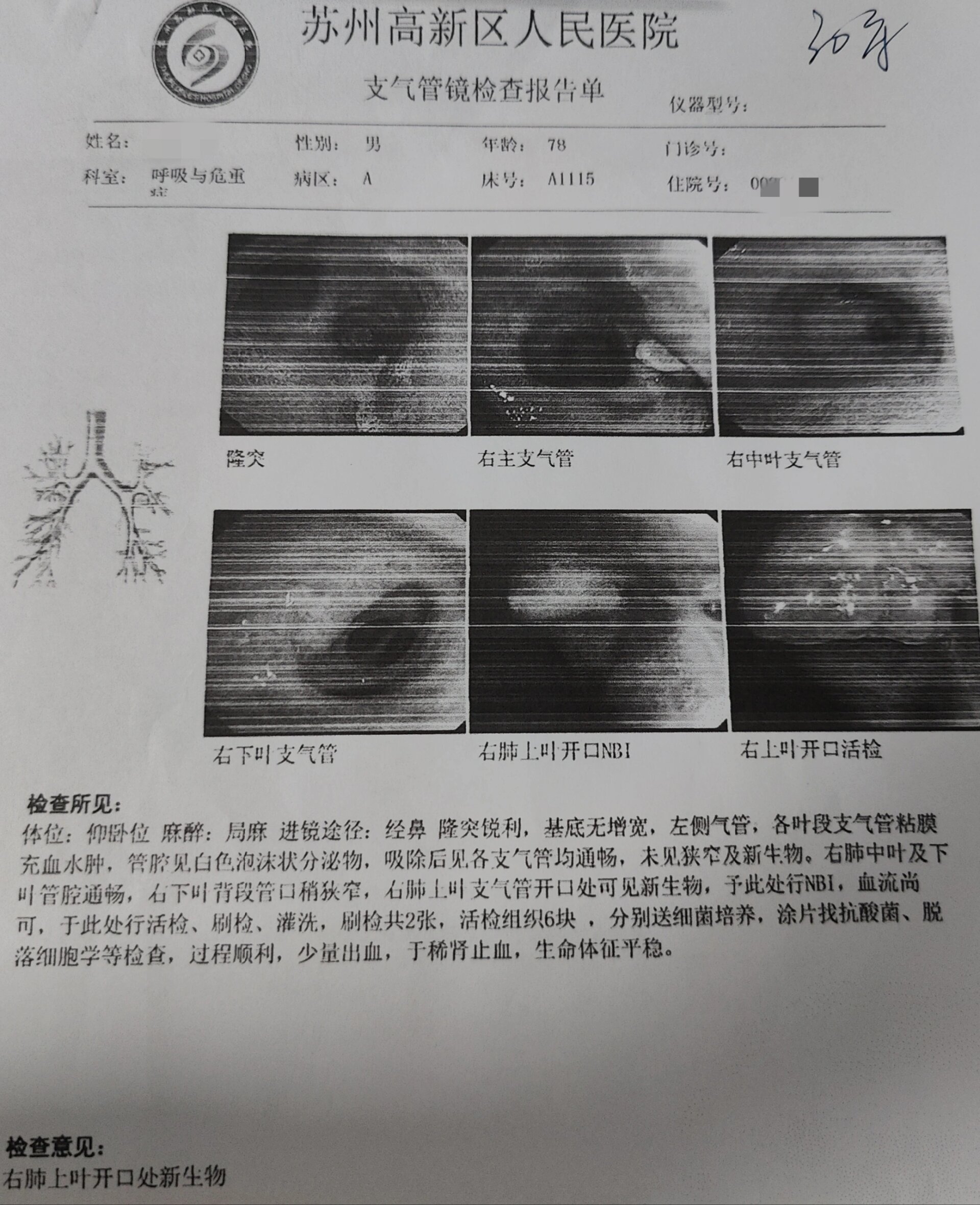 中央型肺癌报告图片