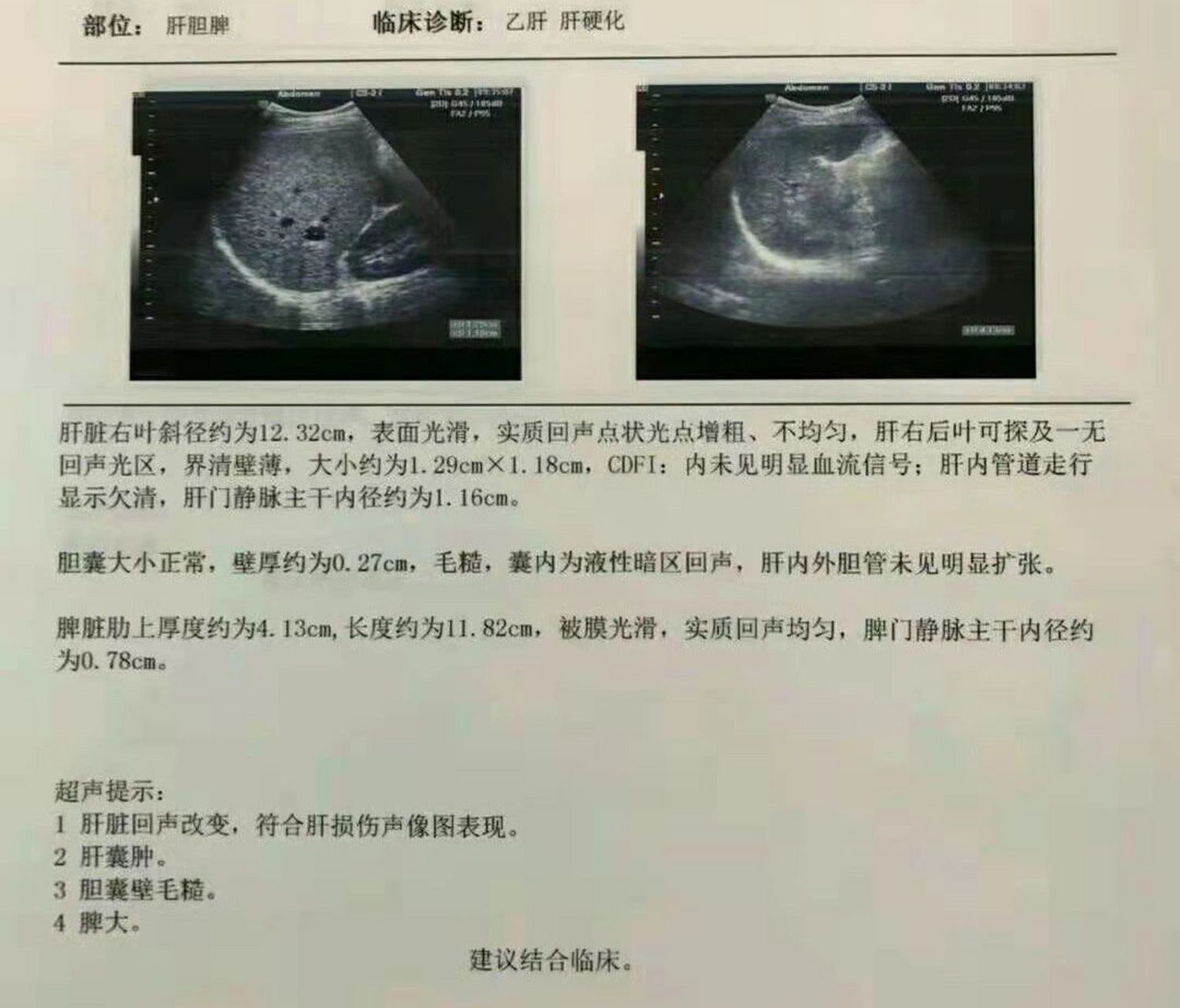 肝硬化常见b超描述 乙肝患者多注意 1.肝实质回声增粗增强 2.