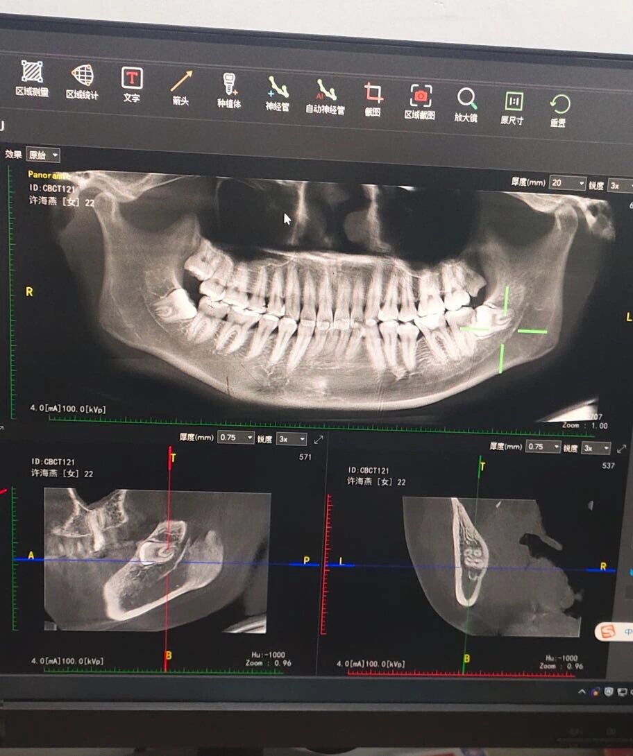 智齿ct图解析图片