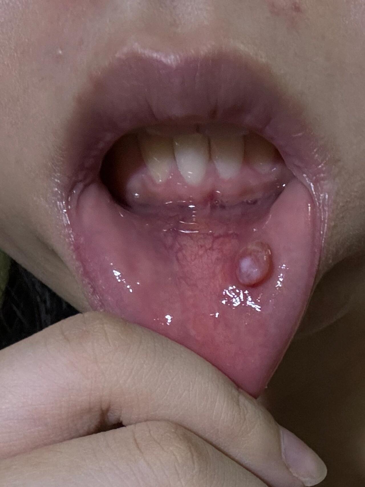 粘液腺囊肿别害怕!