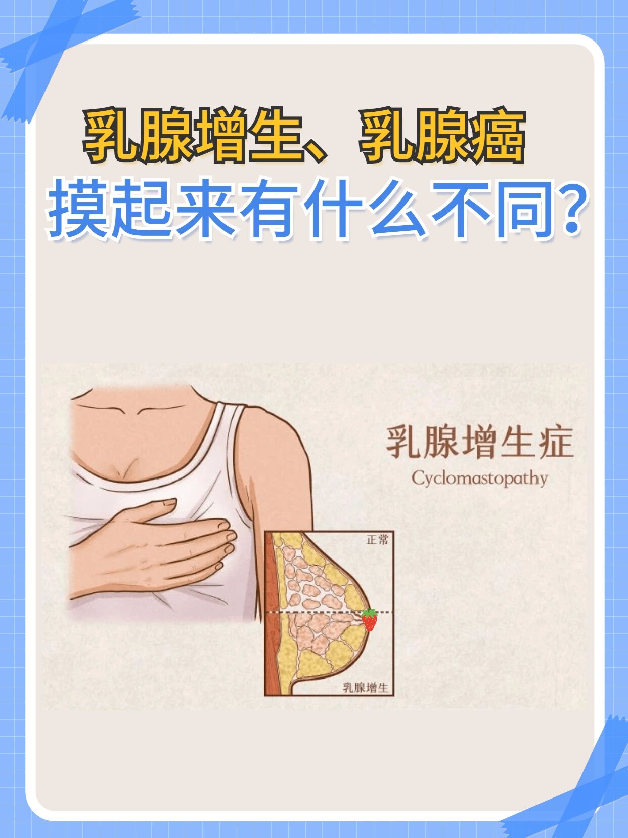 重度乳腺增生图片