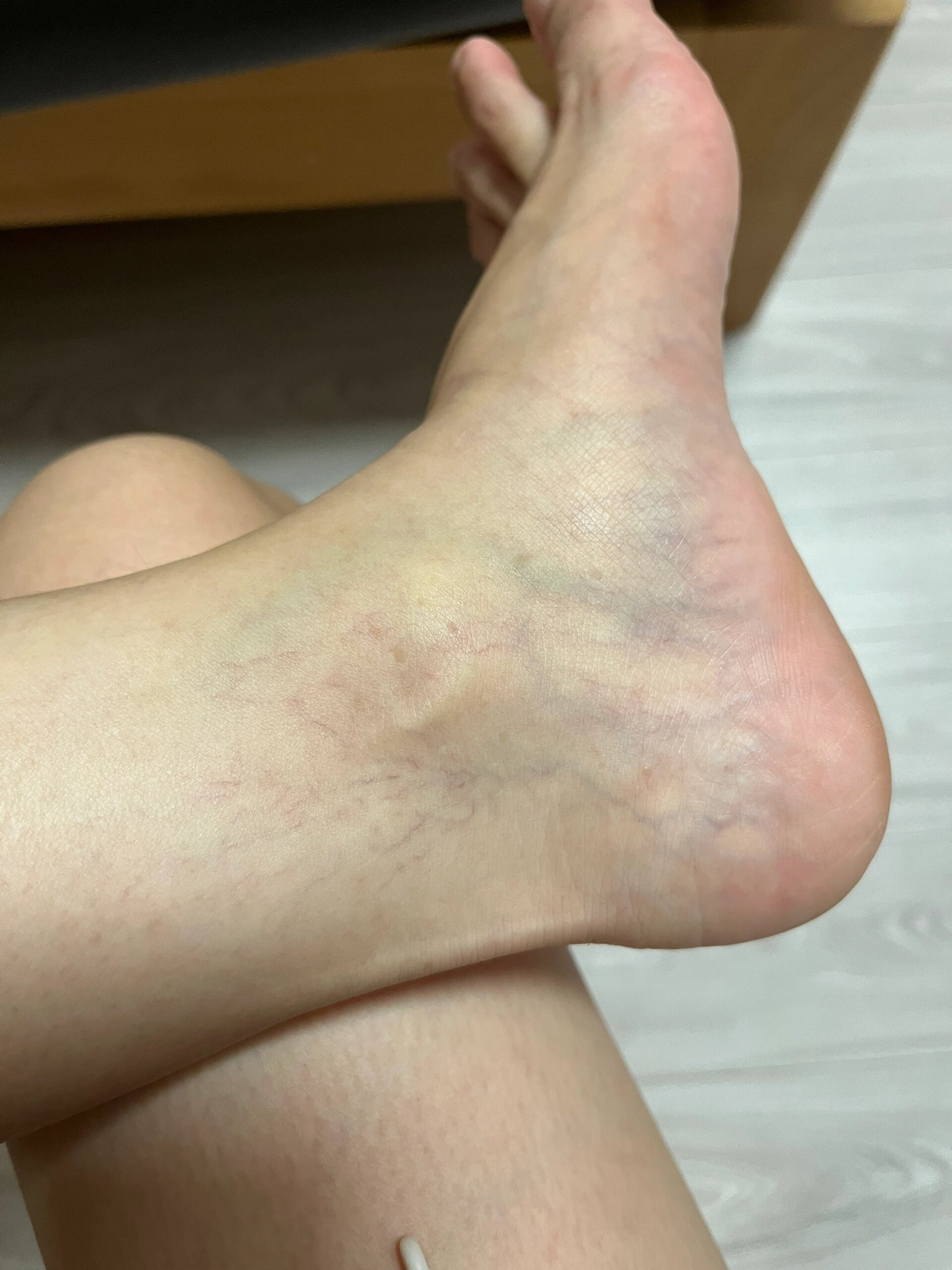 工作需要长时间站立的都容易获静脉曲张