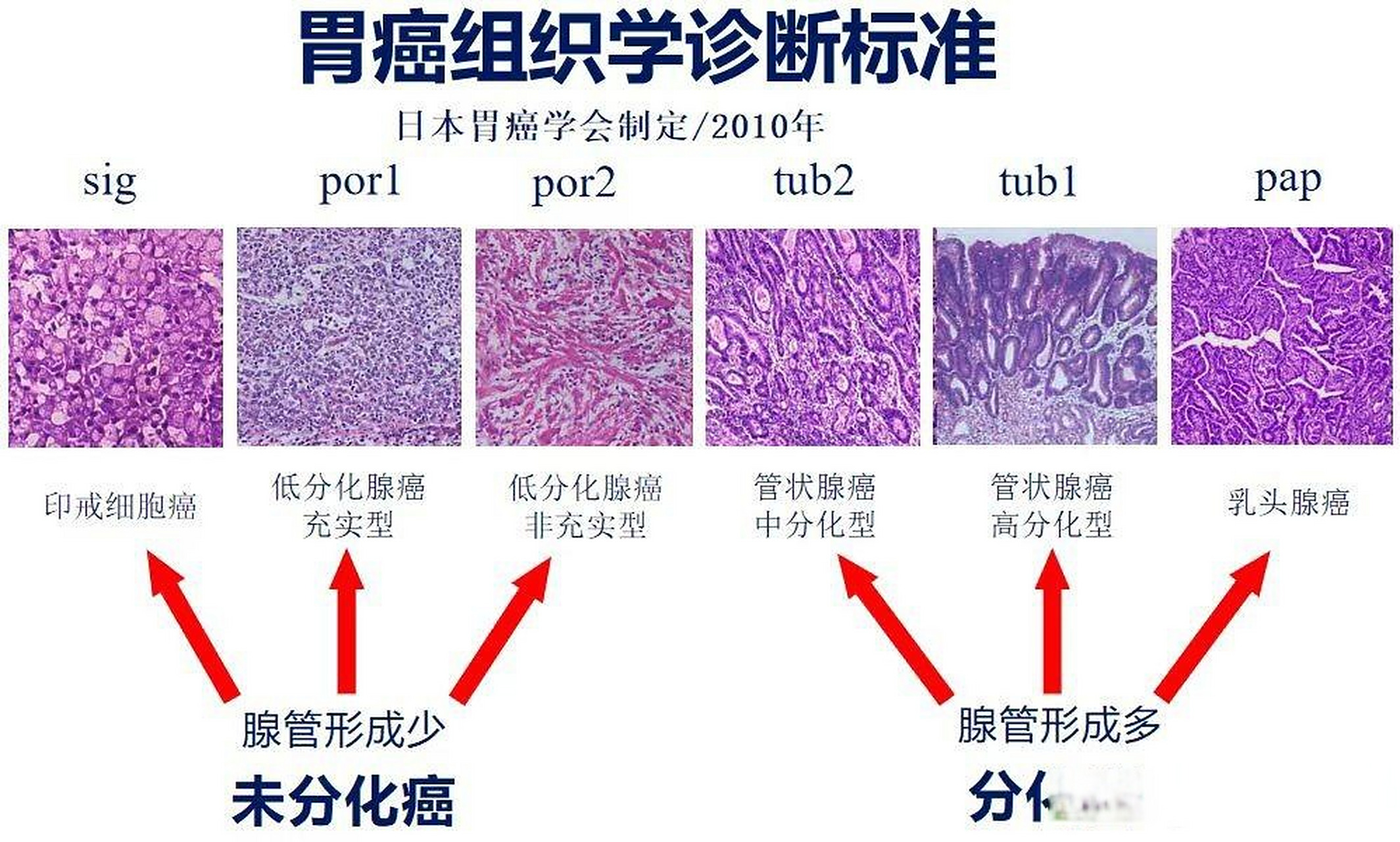 胃癌根据肿瘤细胞的特征,可分为高分化,中分化和低分化三类.
