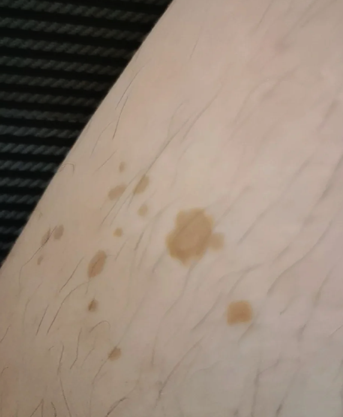 是色素沉着或过敏性紫癜,具体需要到皮肤科检查确诊后才能针对性处理
