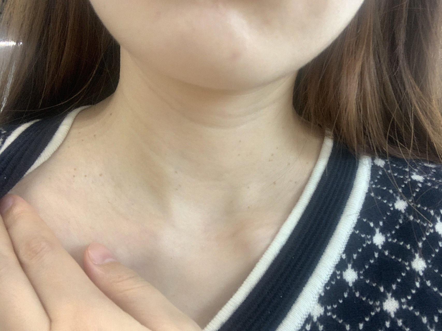 孕31w|孕期长疣 真的好恶心,突然发现脖子上很多小黑点点然后就无法