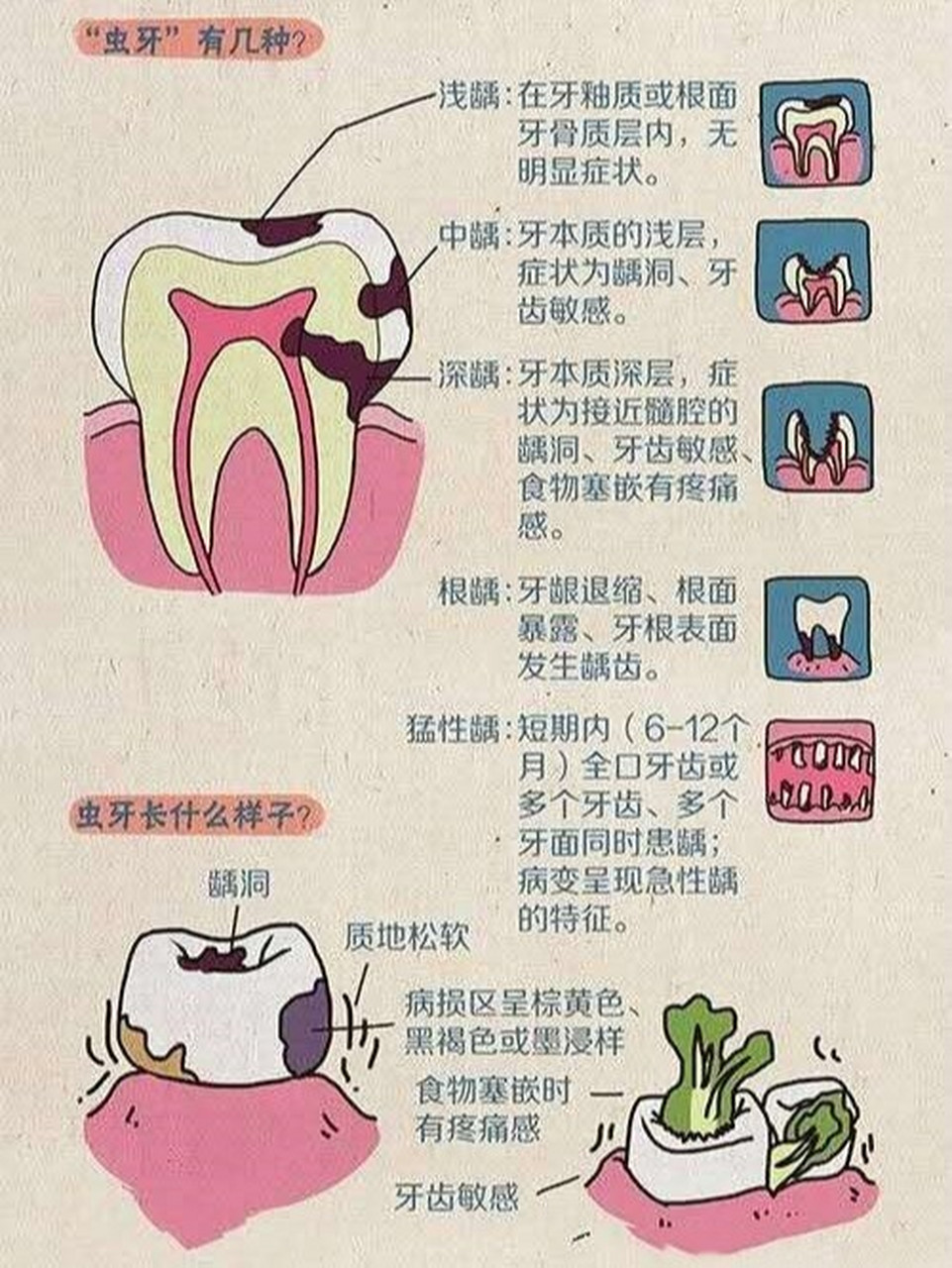 第一阶段:牙齿咬合面有黑线,大牙一般最常见,说明开始蛀牙了,牙釉质被