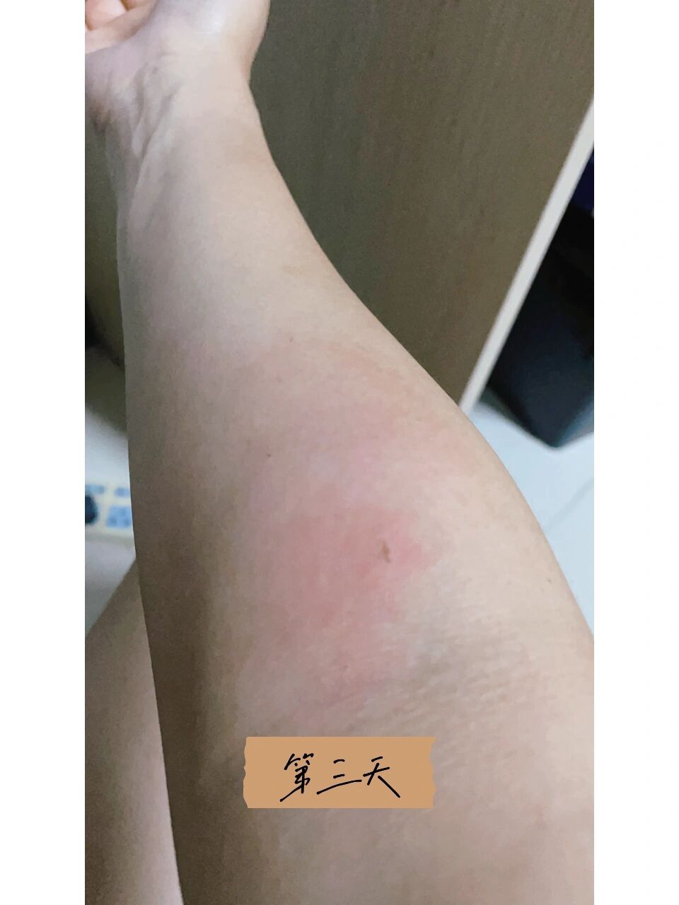 真实体验了一下93蜂蜇伤 被一只小蜜蜂蛰住了胳膊,第一反应赶紧把刺