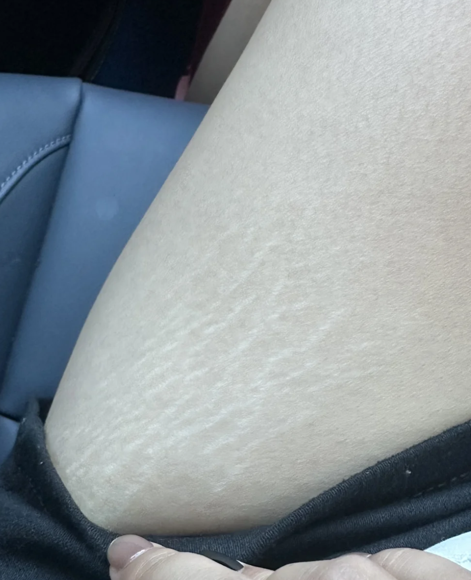 肥胖纹会不会一直长,主要看体重变化情况