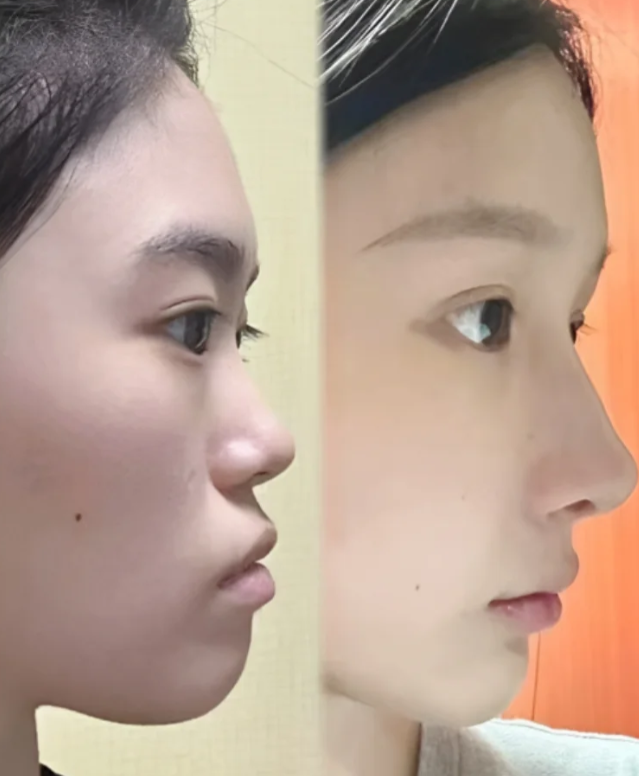 我鼻子非常塌短,鼻基底还有点凹陷,面中不是很好看 不想做正颌感觉