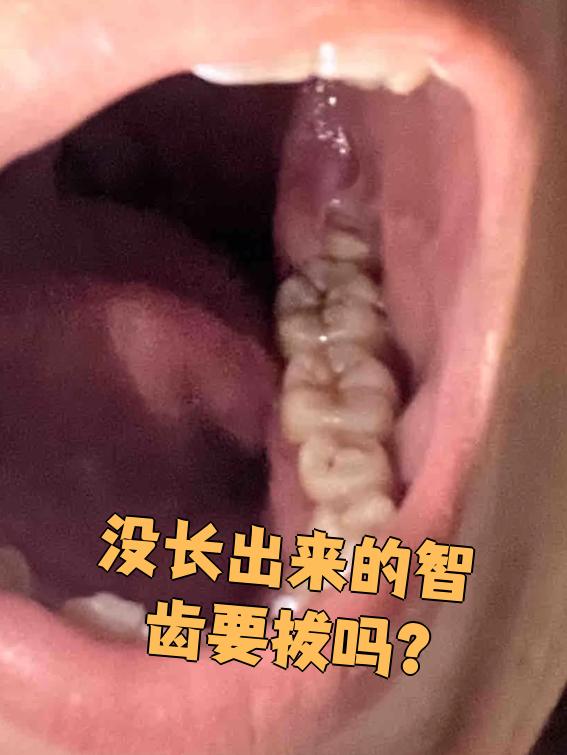 如果拍片检查发现智齿位置较正,有对应的上牙或下牙,咬合关系正常