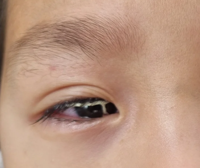 这种情况通常和细菌性结膜炎,睑腺炎,角膜炎等疾病有关