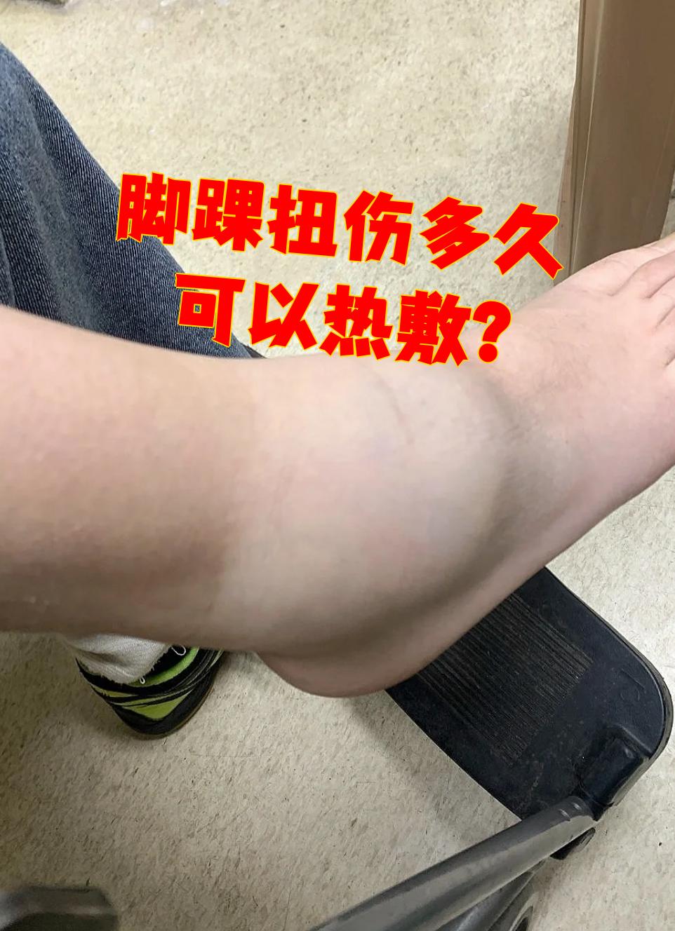脚踝扭伤后通常需要等24小时才能开始热敷