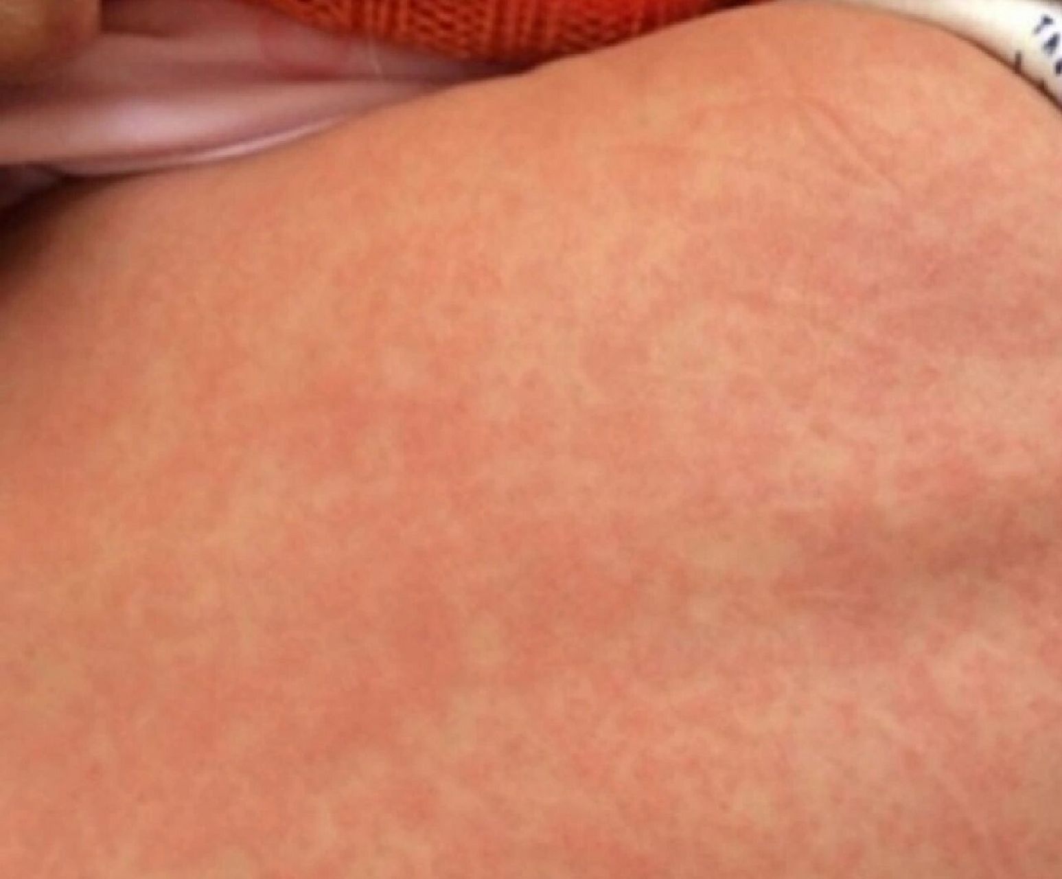 幼儿急疹一定要用清热解表的药 我家孩子第一次疹子没发出来(图二)