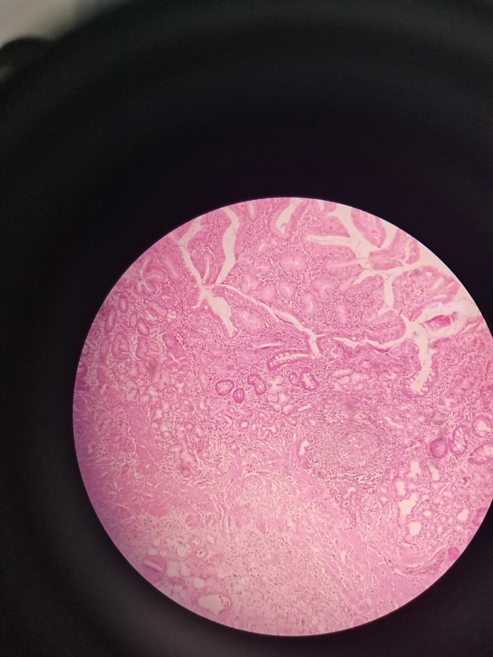 镜下的慢性胃溃疡,看看都知道吗?