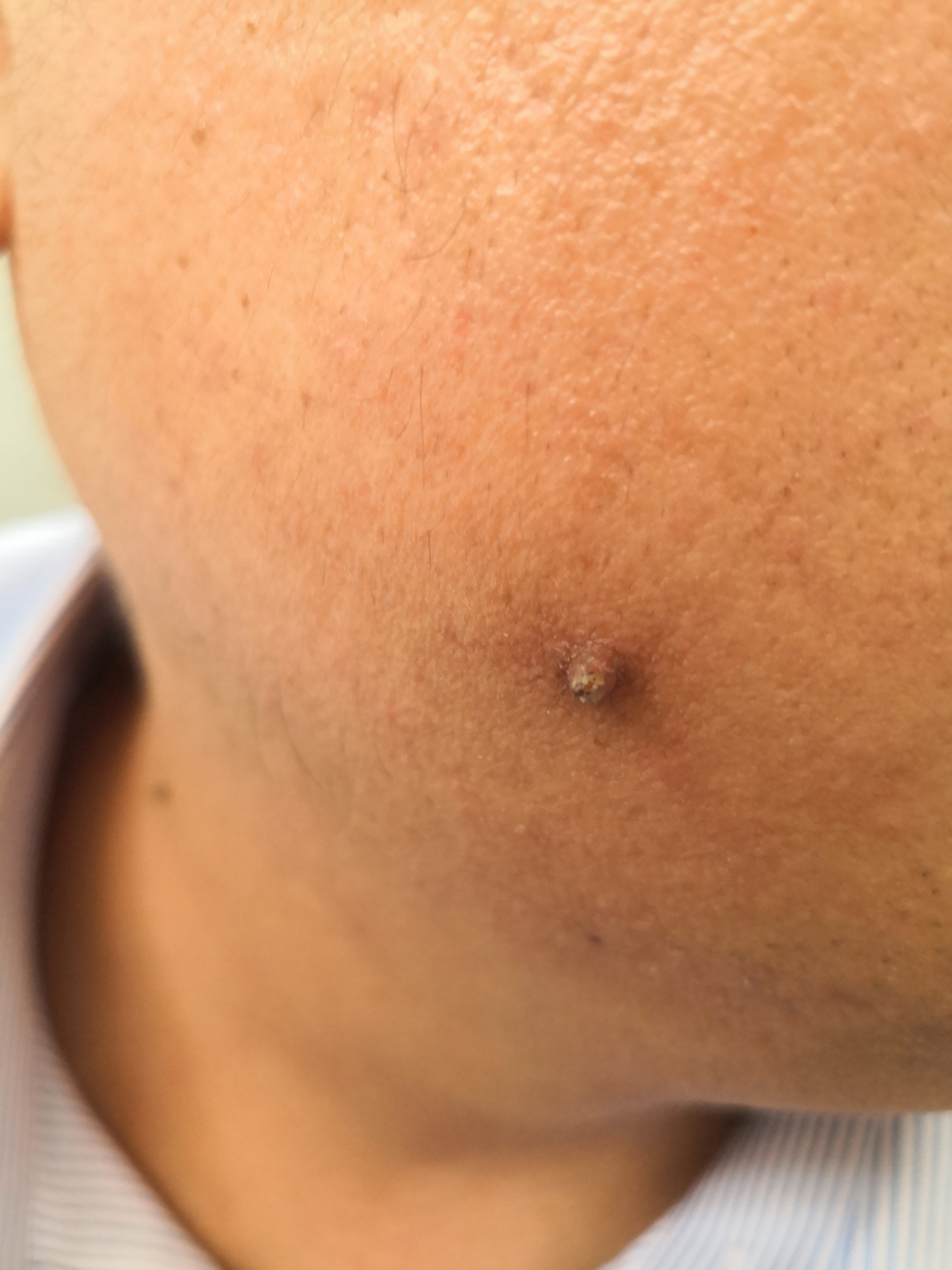 面部颈周增生物.考虑寻常疣和皮赘症状.