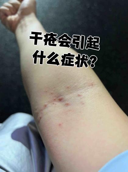 干疮最典型的症状就是皮肤瘙痒,而且痒得特别厉害