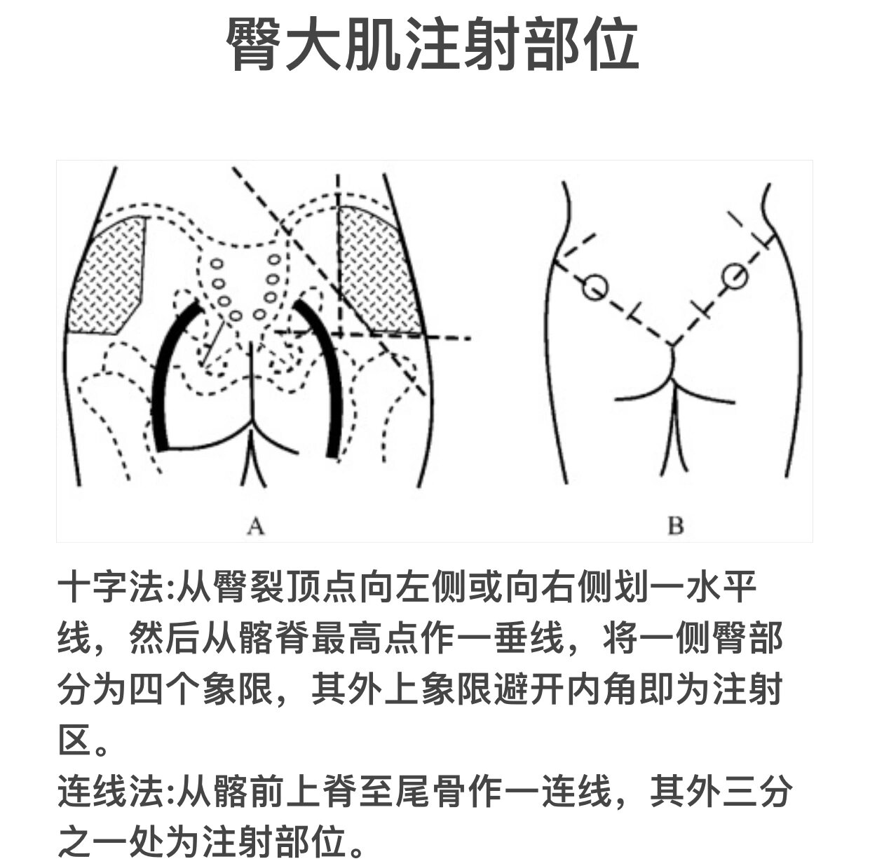 向右侧划一水平线,然后从髂脊最高点作一垂线,将一侧臀部分为四个象限