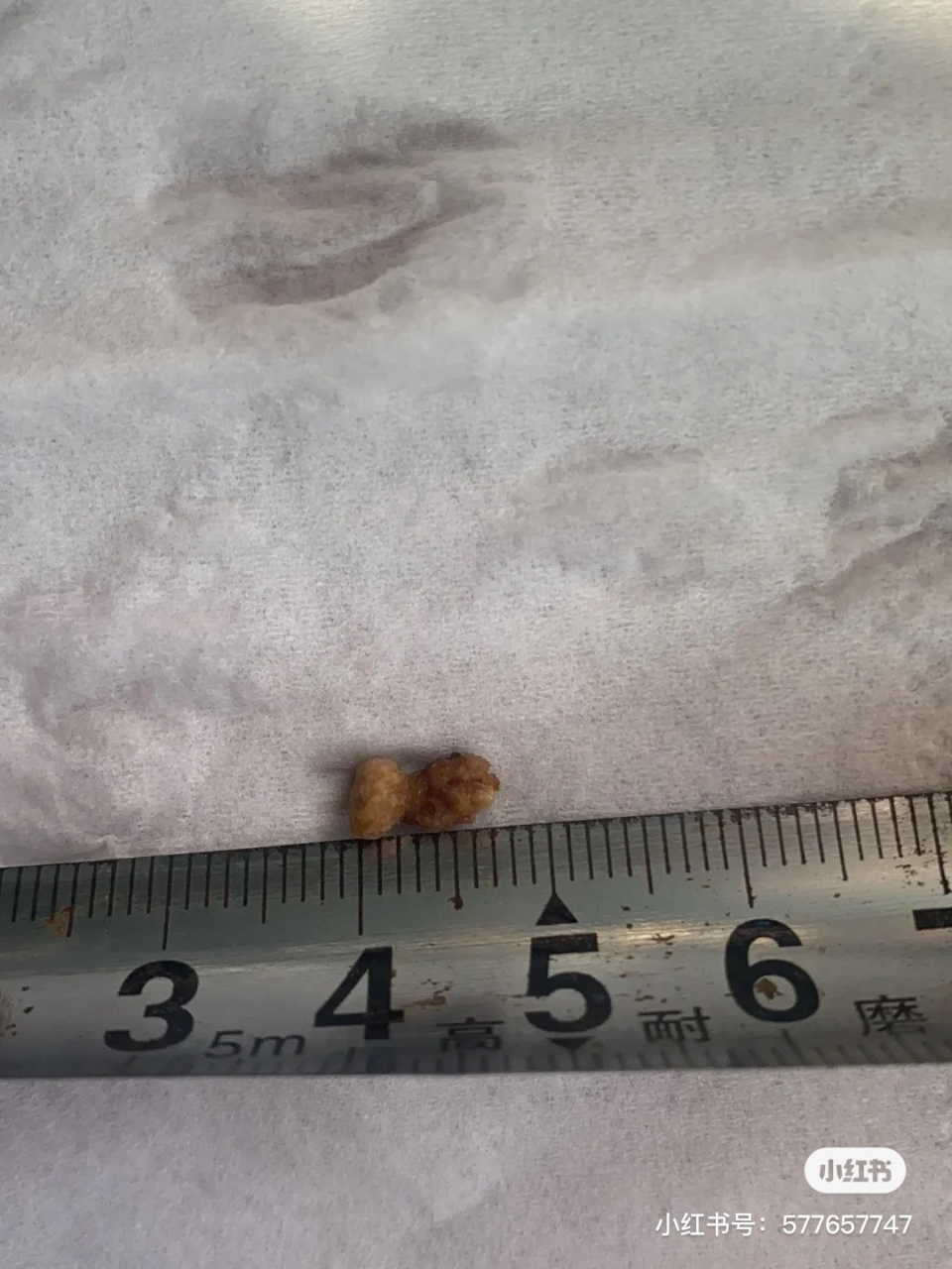 这2年的结石,最大0.8公分