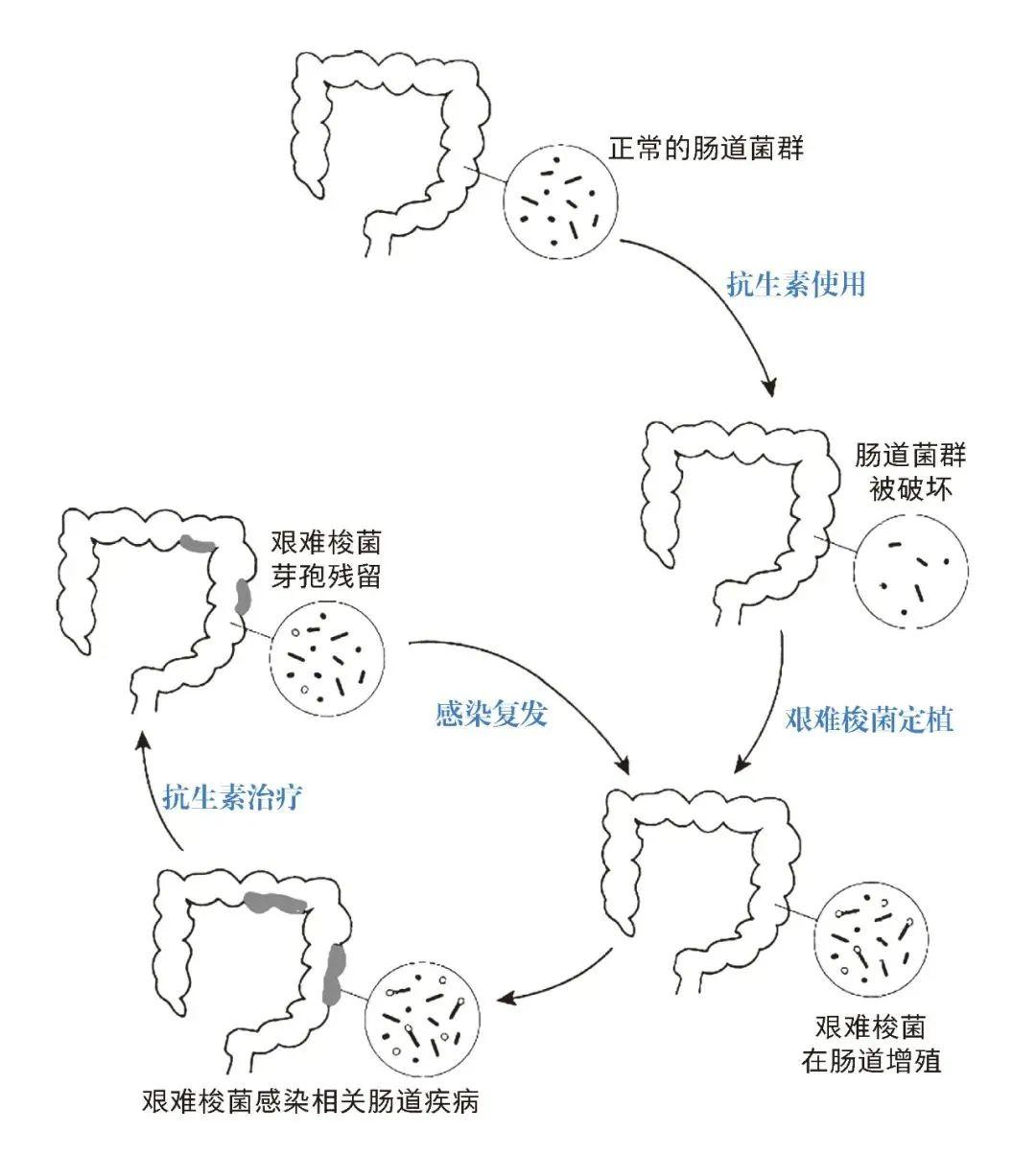 有一种腹泻叫艰难梭菌感染严重时会威胁生命