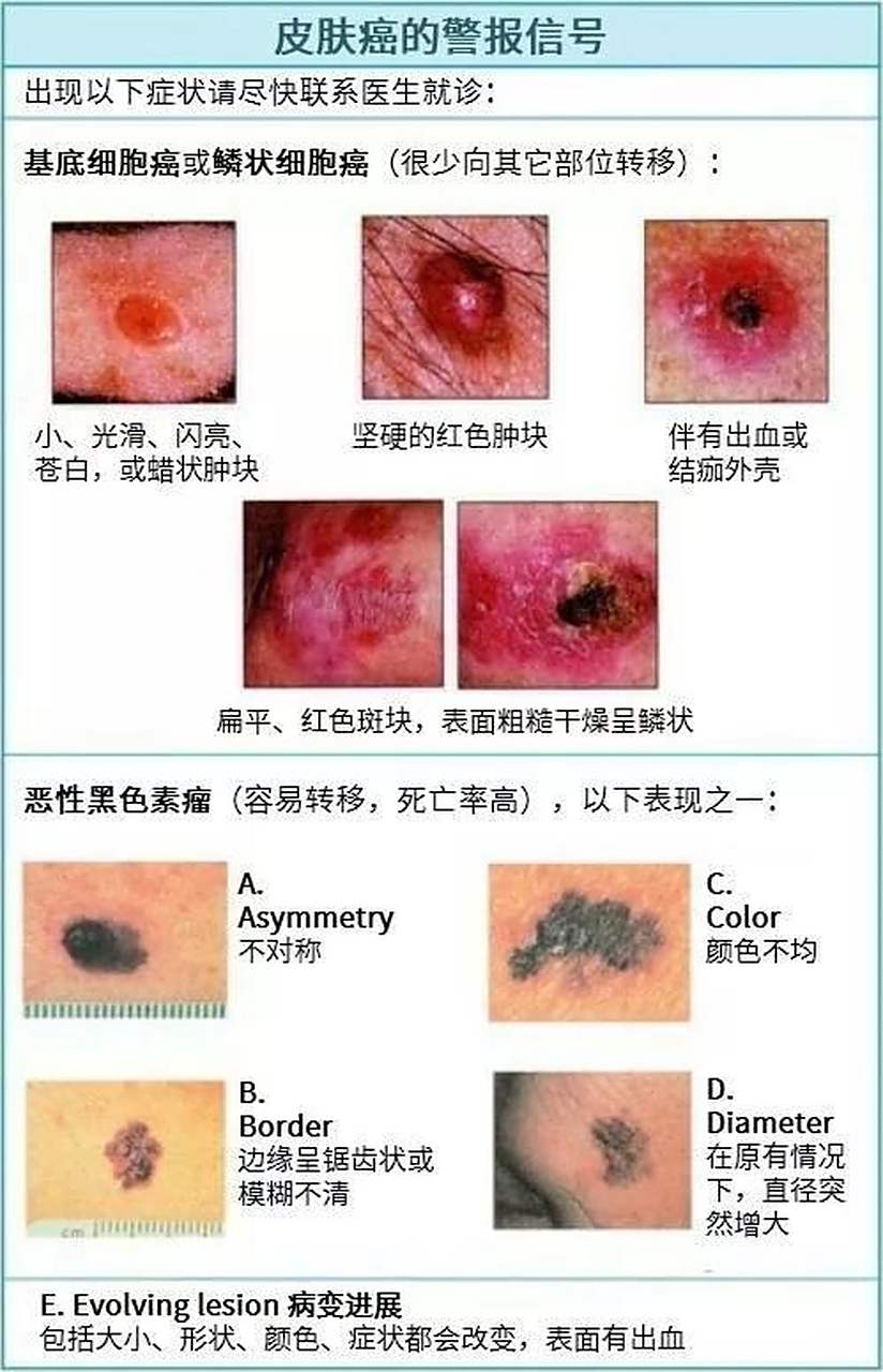 如何鉴别恶性黑色素瘤和普通色素痣   一,如何区分普通痣和黑色素瘤?