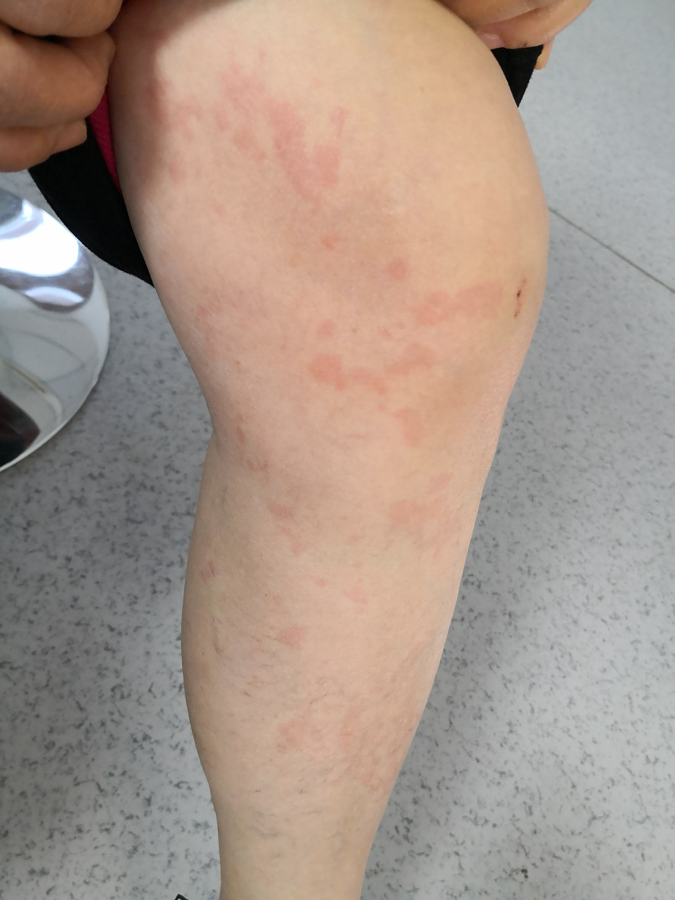 是荨麻疹症状#过敏##荨麻疹