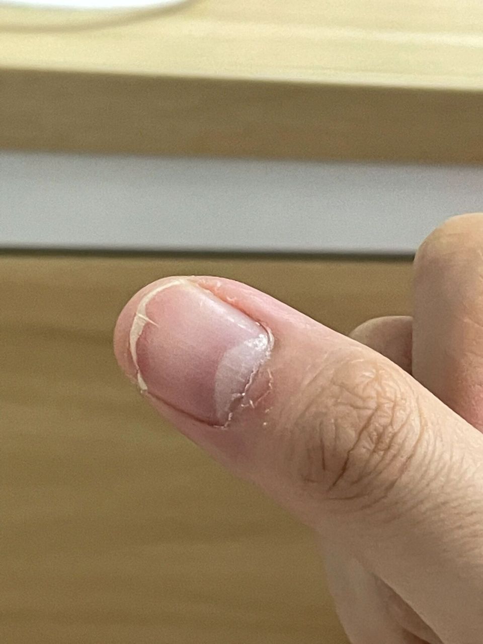 手指甲这样中间裂开我该怎么办