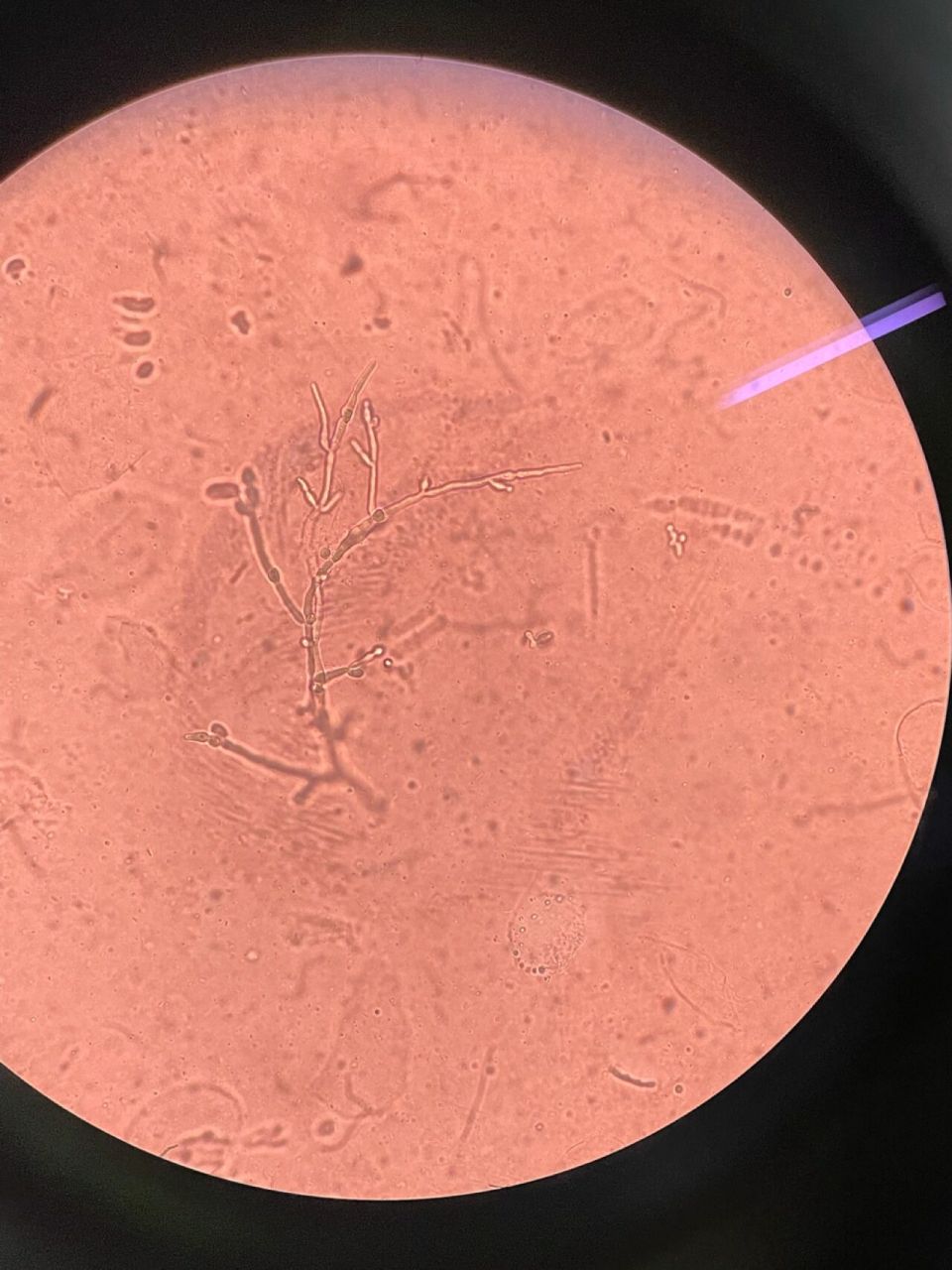 霉菌孢子显微镜🔬图 霉菌性阴道炎是我国妇科门诊最常见的阴道炎症